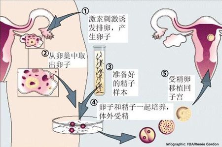 液氮存储
